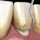 Plastyka dziąseł dentysta stomatologia estetyczna
