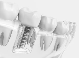 Korony cyrkonowe na implantach Toruń