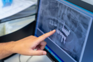 RTG zębów w stomatologii - dentysta rtg